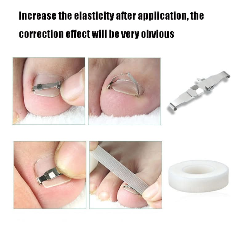 Orthopedic Buckle Toe Nail Groove Ingrown Nail Corrector Reluova